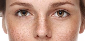 Best At Home Chemical Peels for Hyperpigmentation