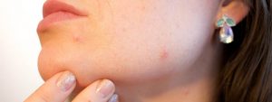 Laser Treatment for Acne Scars: Is It The Answer?