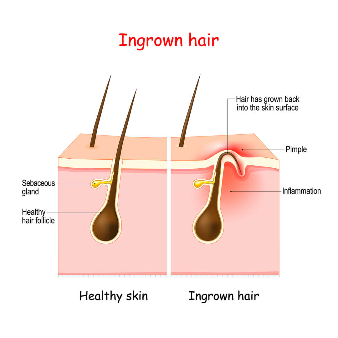 Ingrown-hair
